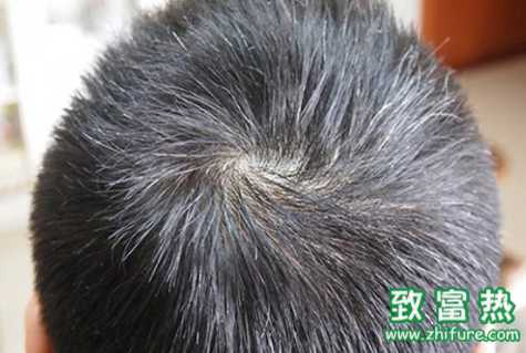 白頭發(fā)拔了會對身體造成傷害嗎