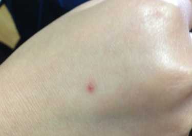 被蚊子咬了以后如何止癢