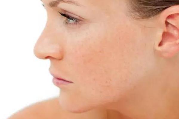 柿子葉怎么祛斑