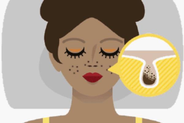 獼猴桃可以祛斑嗎