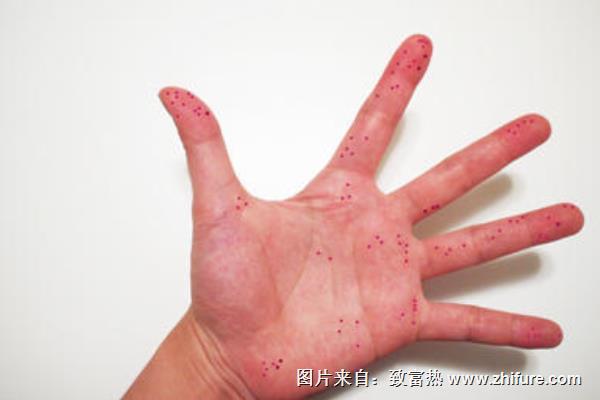 剁辣椒手辣手燒怎么辦