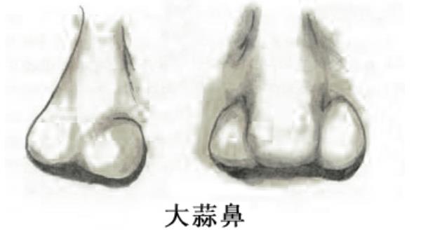 蒜頭鼻圖片大全