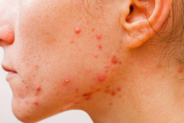 花椒過敏怎么辦?