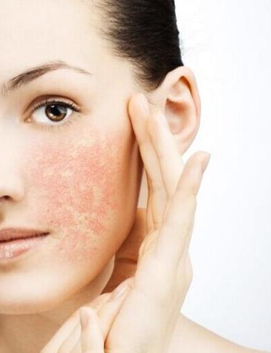 花椒過敏怎么辦?