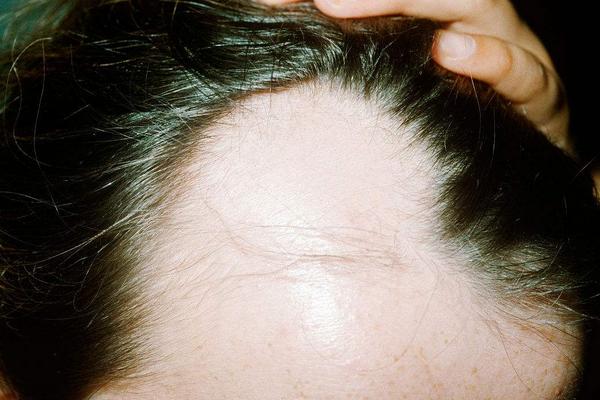 花椒生發(fā)嗎?