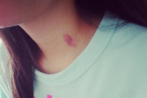 脖子上被種草莓怎么快速消除