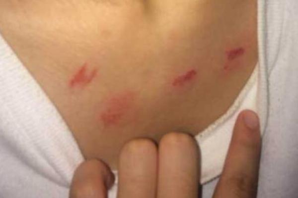 脖子上被種草莓怎么快速消除