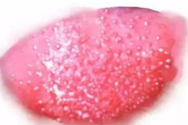 楊梅舌是什么病-