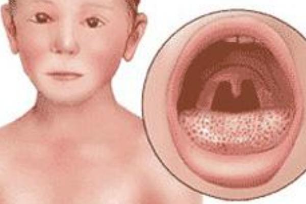 楊梅舌是什么病-