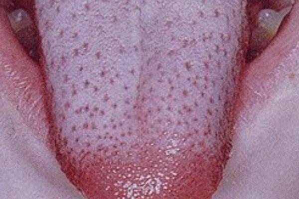 楊梅舌是什么病-