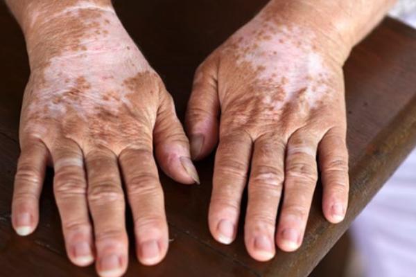 無花果葉治療白斑的方法