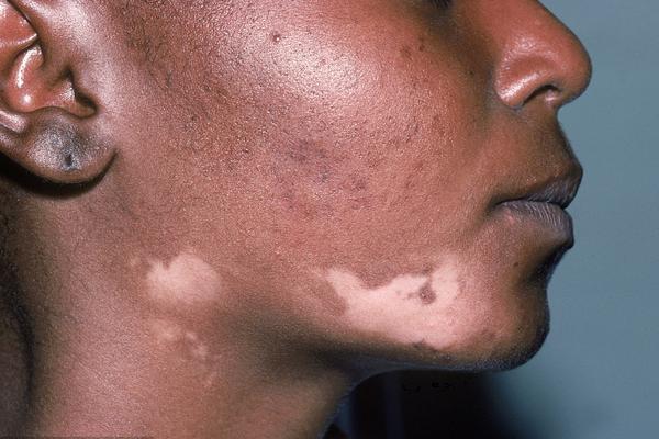 無花果葉治療白斑的方法