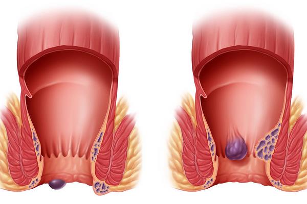 無花果能治痔瘡嗎