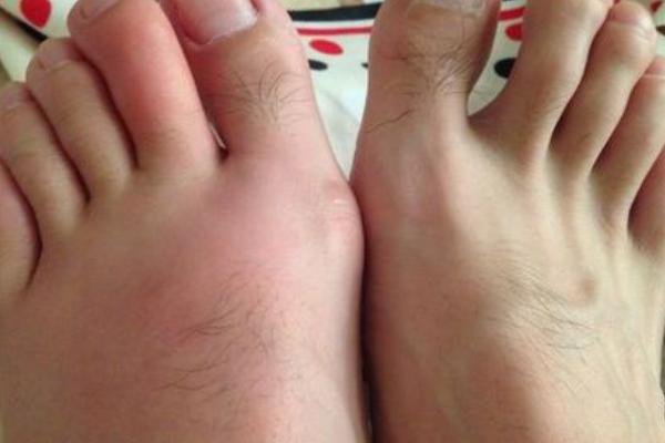 被蜈蚣咬了有什么癥狀？