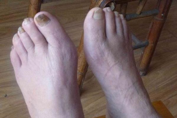 痛風能吃花生嗎？