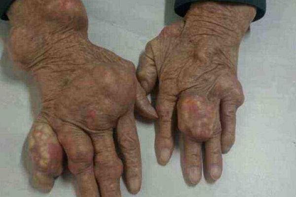 痛風能吃花生嗎？