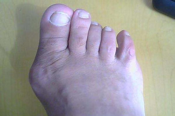 痛風能吃花生嗎？