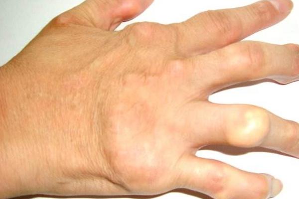 痛風能吃花生嗎？