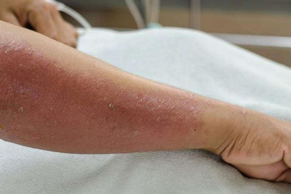 菠菜過敏的癥狀 吃菠菜過敏怎么辦