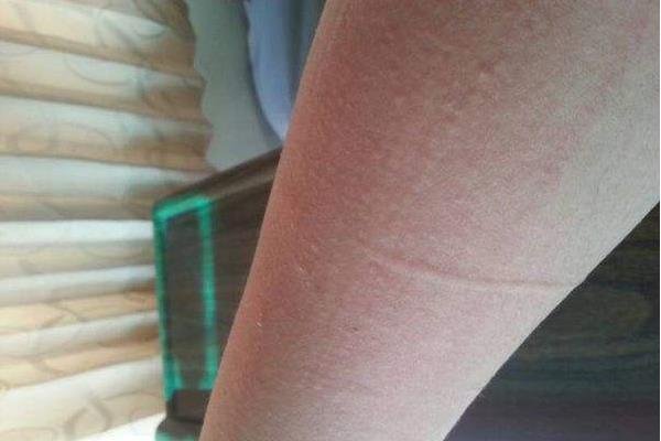 吃芹菜過敏癥狀及處理方法