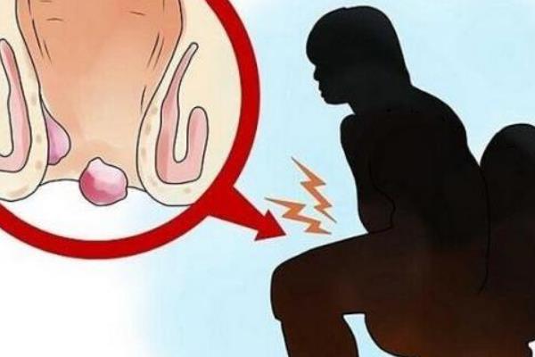 魚腥草能治痔瘡嗎 魚腥草治療痔瘡的做法