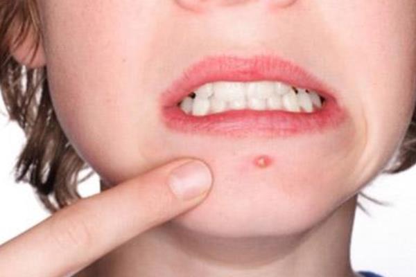 夏天臉上長痘痘怎么治 夏季快速消除痘痘的方法