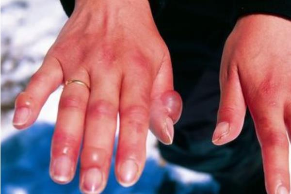 冬天手凍了生凍瘡了怎么辦 冬天怎么防止凍傷