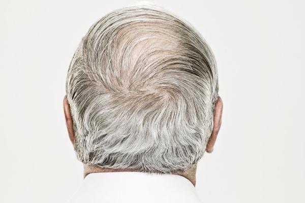 吃桑葚治療白發脫發嗎 怎么自制桑葚染發劑