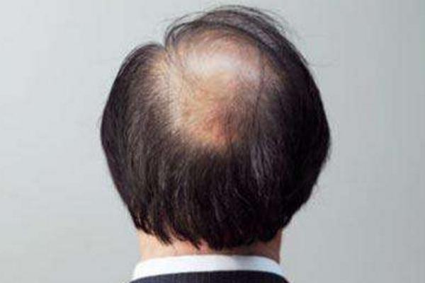 夢見自己禿頂是什么意思 女人夢到自己半禿頂有什么預兆