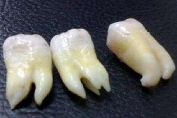 夢見牙齒掉了是什么意思 女人夢見掉了很多顆牙齒有什么預兆