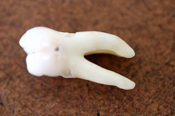 夢見牙齒掉了是什么意思 女人夢見掉了很多顆牙齒有什么預兆