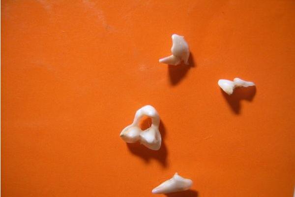 夢見牙齒掉了是什么意思 女人夢見掉了很多顆牙齒有什么預兆