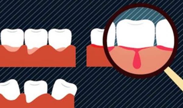 夢見掉門牙是什么意思 女人夢到自己2顆大門牙掉了有什么預兆