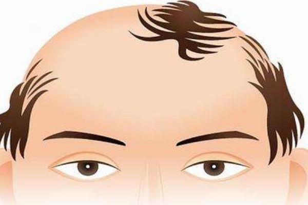 夢見掉頭發什么意思 夢到自己大量掉頭發有什么預兆