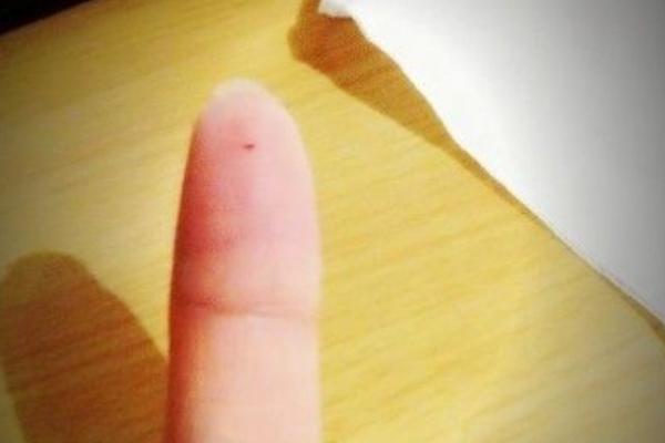 夢見扎針是什么意思 夢見別人給我扎針灸有什么預兆