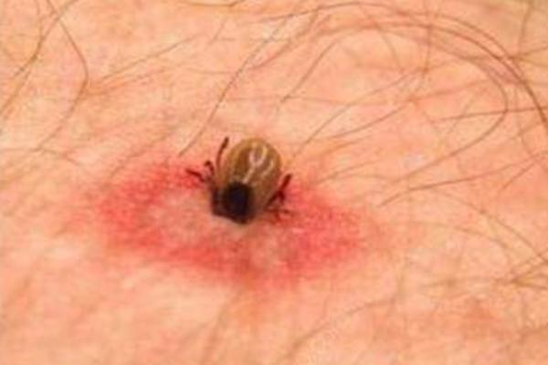 夢見吸血蟲有什么意思 女人夢到吸血蟲鉆到身體里有什么預兆