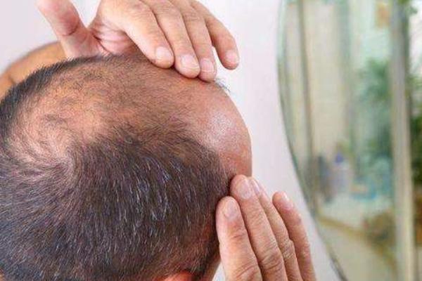 夢見自己頭頂頭發(fā)稀少是什么意思 夢到自己頭頂禿了一塊有什么預兆