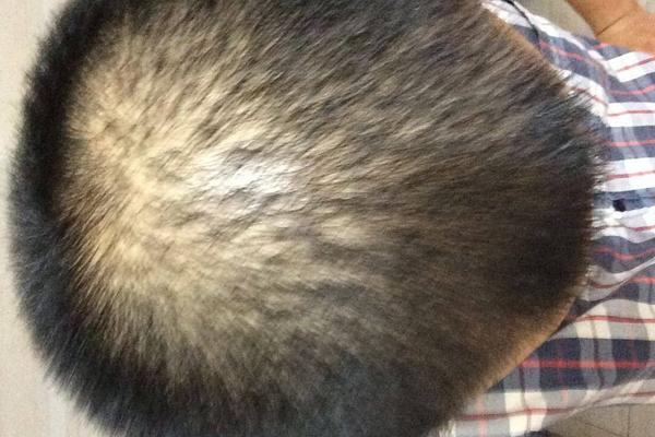 夢見自己頭頂頭發(fā)稀少是什么意思 夢到自己頭頂禿了一塊有什么預兆