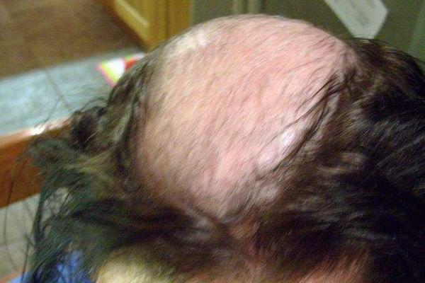 夢見自己頭頂頭發(fā)稀少是什么意思 夢到自己頭頂禿了一塊有什么預兆