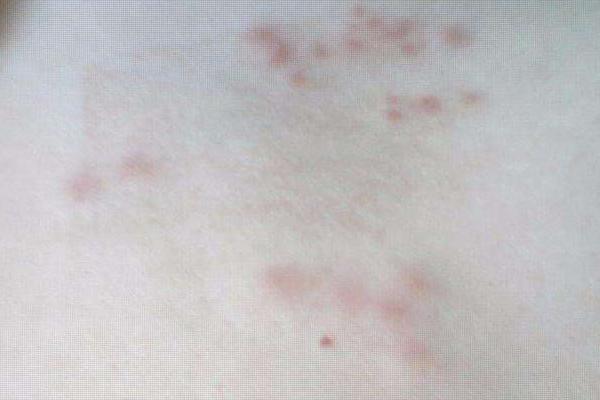 夢見身上起紅疙瘩是什么意思 夢到身上癢有紅點有什么預兆