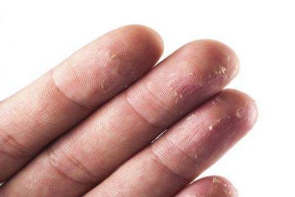 夢見手脫皮是什么意思 夢到手脫皮自己去剝有什么預兆