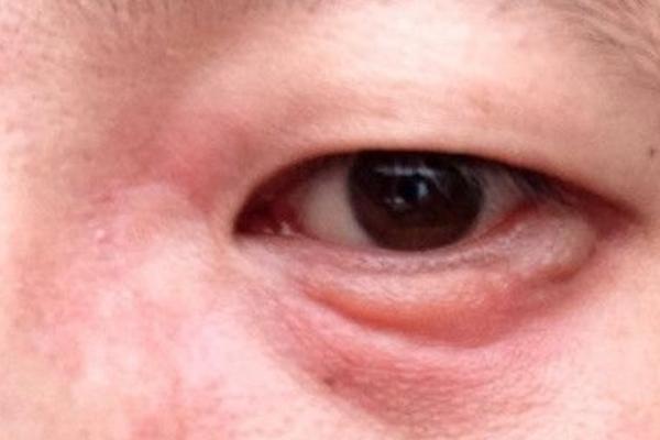 夢(mèng)見(jiàn)眼睛腫了是什么意思 女人夢(mèng)到自己眼睛腫了打不開(kāi)有什么預(yù)兆