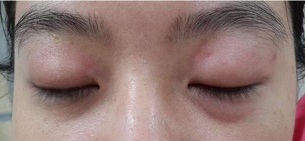 夢(mèng)見(jiàn)眼睛腫了是什么意思 女人夢(mèng)到自己眼睛腫了打不開(kāi)有什么預(yù)兆