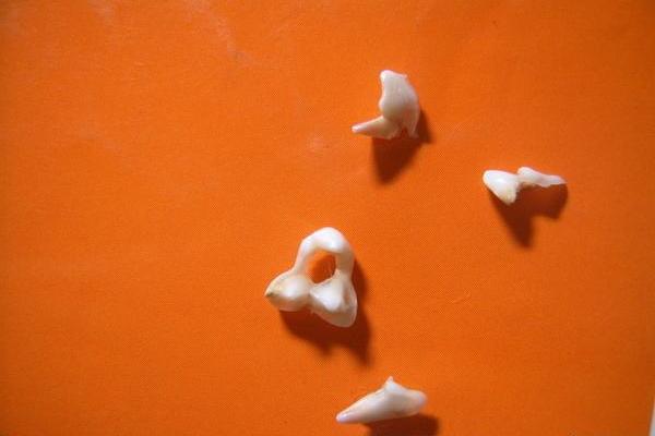 夢見掉牙齒是什么意思 夢到掉了一大把牙齒并吐出來有什么預兆