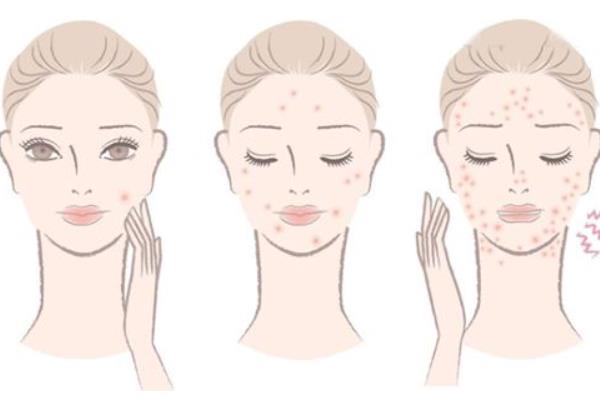 夢(mèng)見(jiàn)自己過(guò)敏是什么意思 夢(mèng)到自己全身是疙瘩有什么預(yù)兆