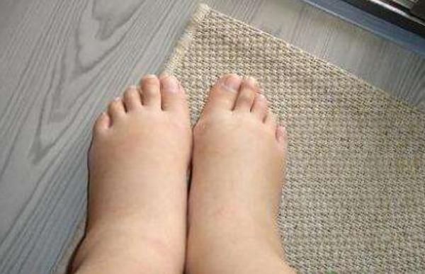 夢見腳腫是什么意思 女人夢到自己的腳水腫了有什么預兆