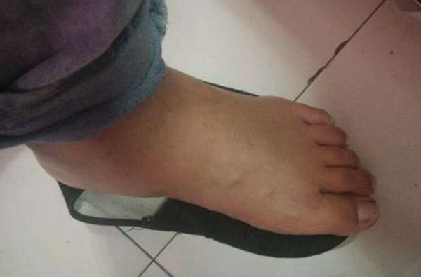 夢見腳腫是什么意思 女人夢到自己的腳水腫了有什么預兆