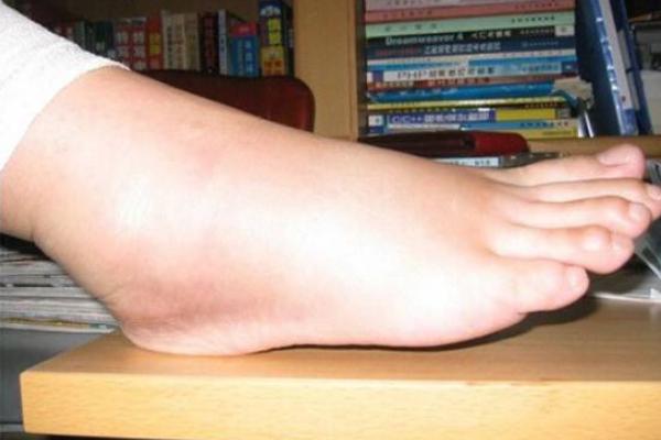 夢見腳腫是什么意思 女人夢到自己的腳水腫了有什么預兆