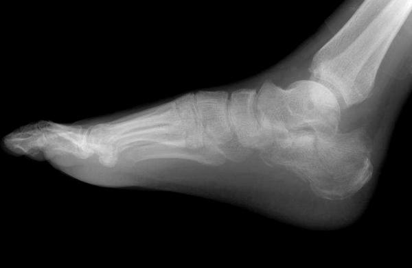 夢見腳上長水泡是什么意思 夢到腳上長瘡有什么預兆