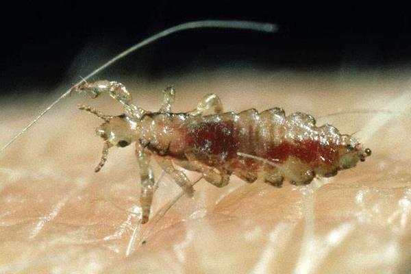 夢見頭上長虱子是什么意思 女人夢到頭上長滿虱子有什么預兆